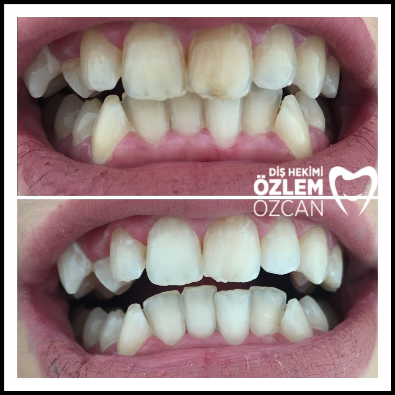 Lazerle Diş Beyazlatma ile İlgili Bilmeniz Gerekenler 5 diş beyazlatma öncesi ve sonrası