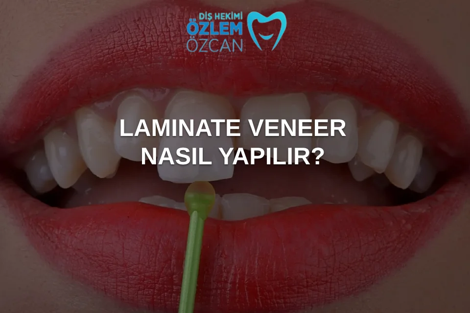 laminate veneer nasıl yapılır