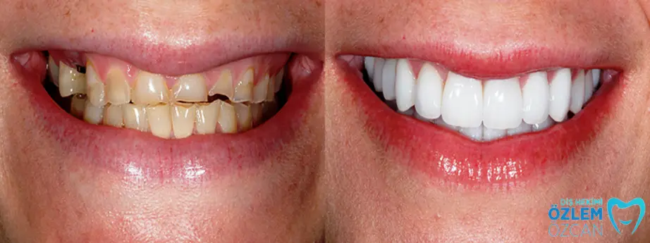 zirkonyum kaplama yaptıranlar öncesi ve sonrası