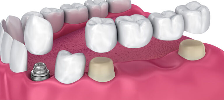 dental bridge in turkey