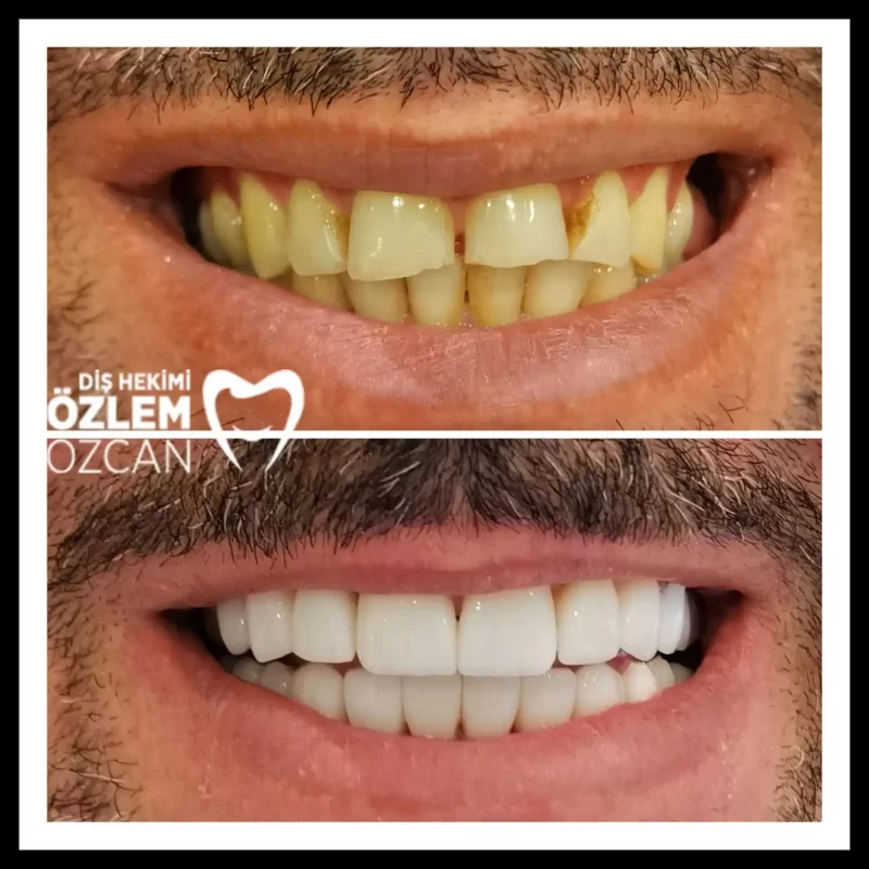 porcelain laminate veneer