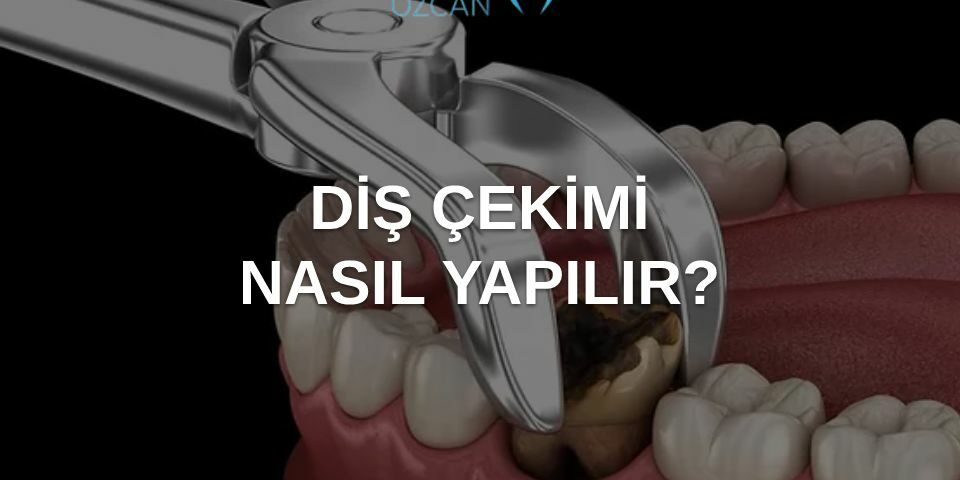diş çekimi