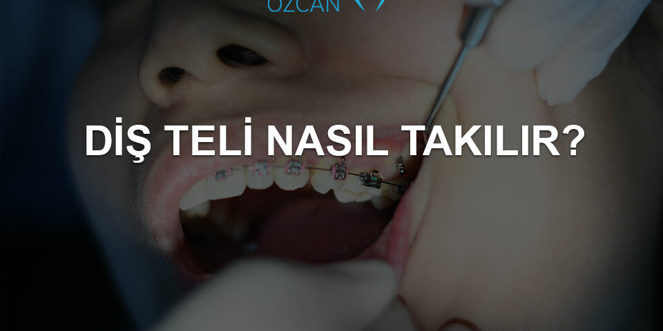 diş teli nasıl takılır