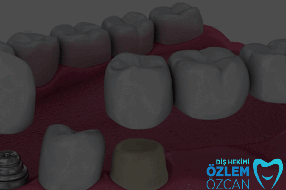 diş protez teknolojisi