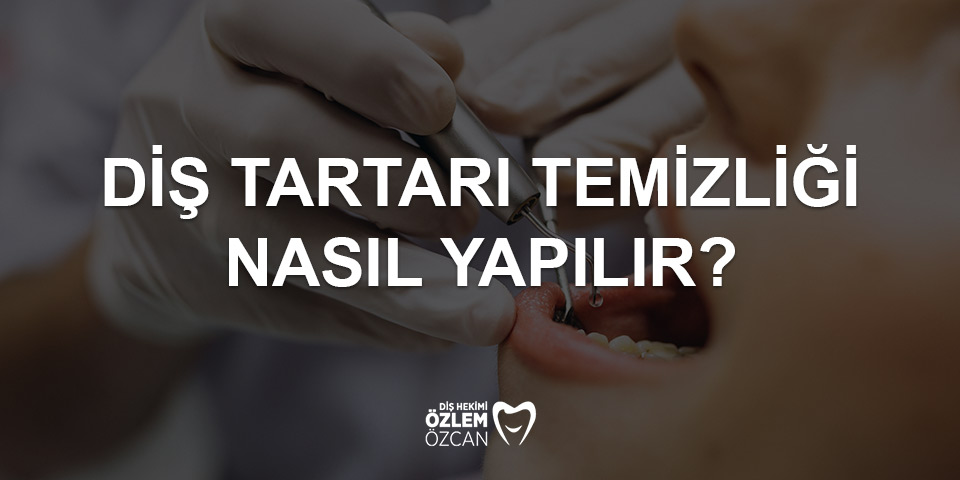 diş tartarı temizliği nasıl yapılır
