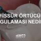 fissür örtücü uygulaması nedir