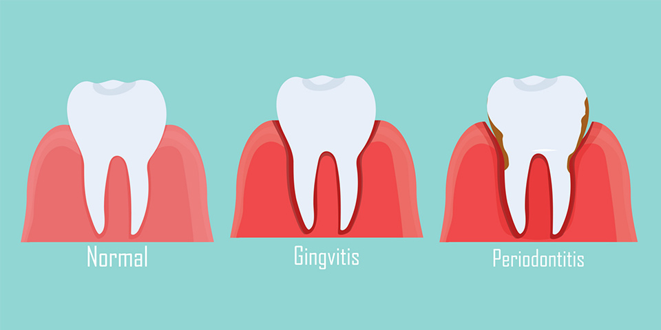 Periodontal Hastalık Nedir ve Nasıl Önlenir? 5 periodontitis nedir