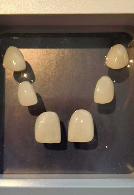 laminate veneer nasil yapilir