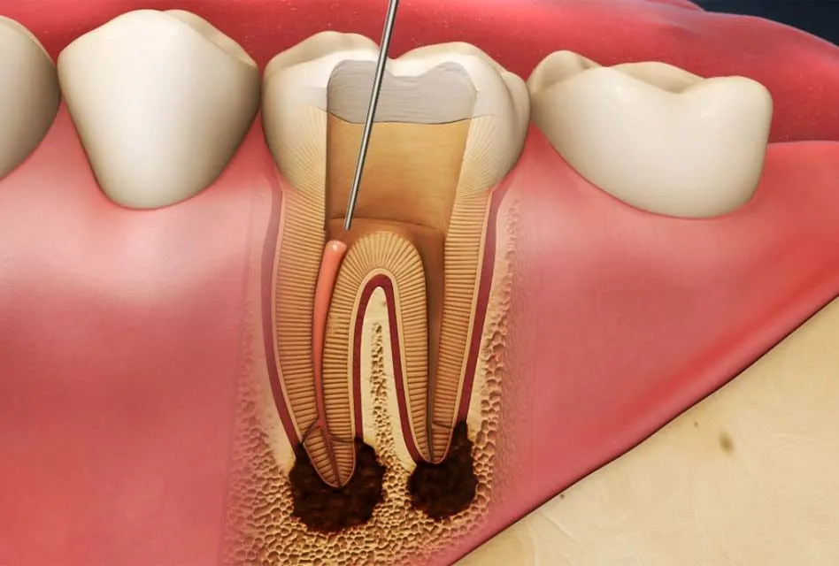 root canal treatment-istanbul cost