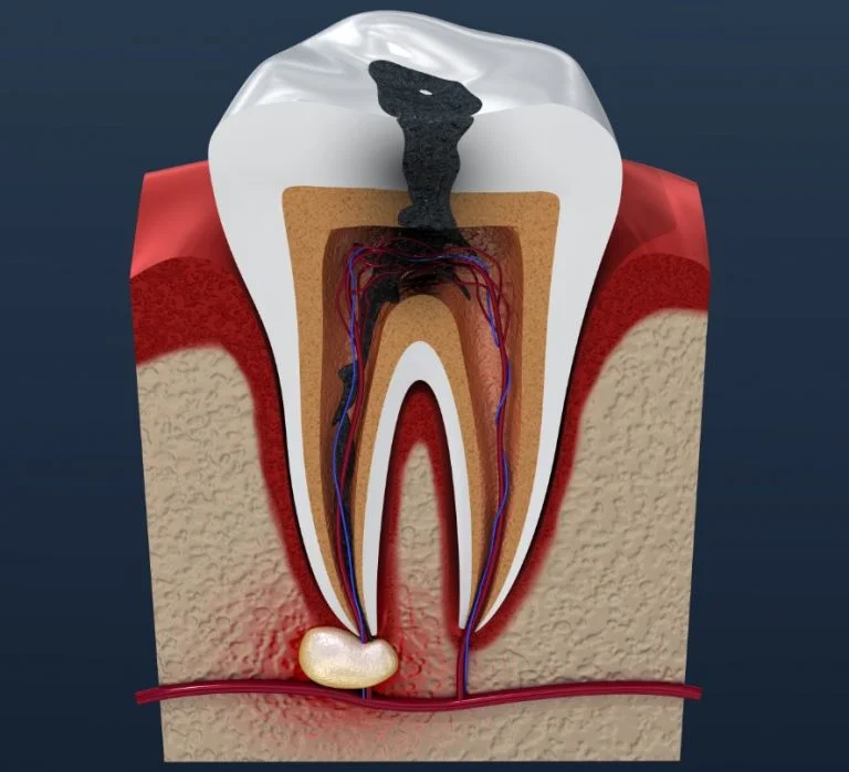 Root Canal Treatment