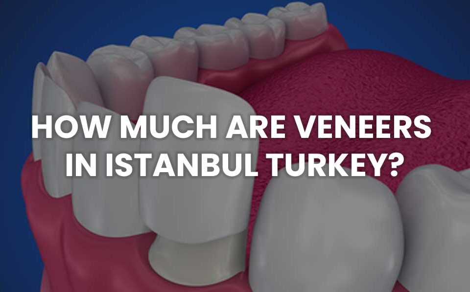 how much are veneers in istanbul turkey