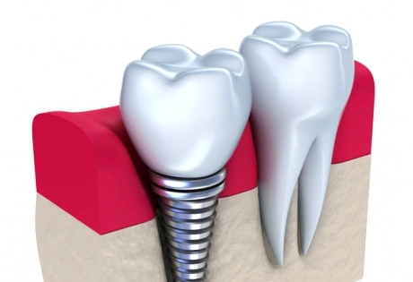 dental implants turkey