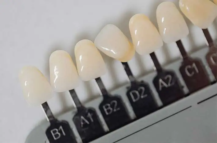 Laminate Veneers