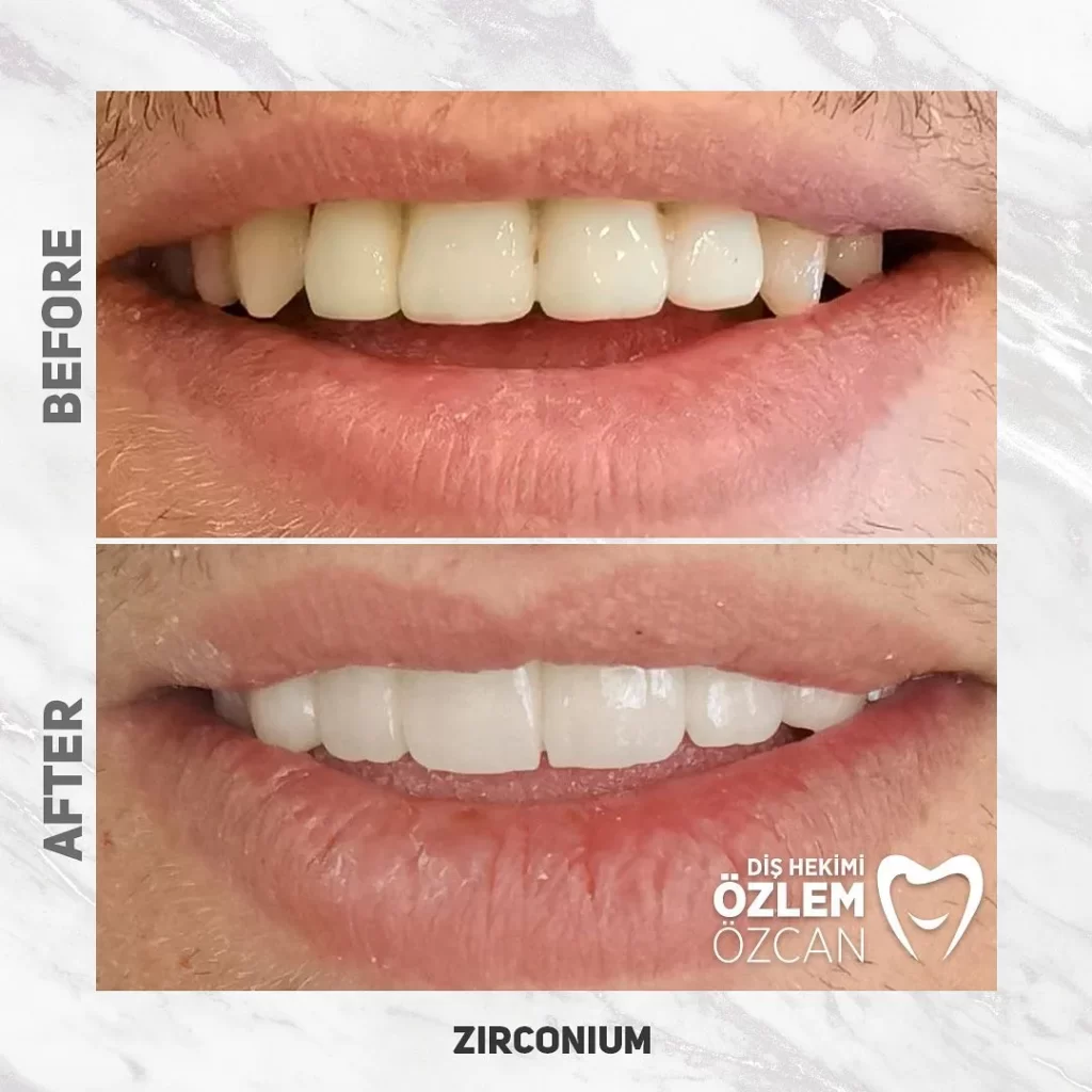 Zirconia Crown Cost Istanbul