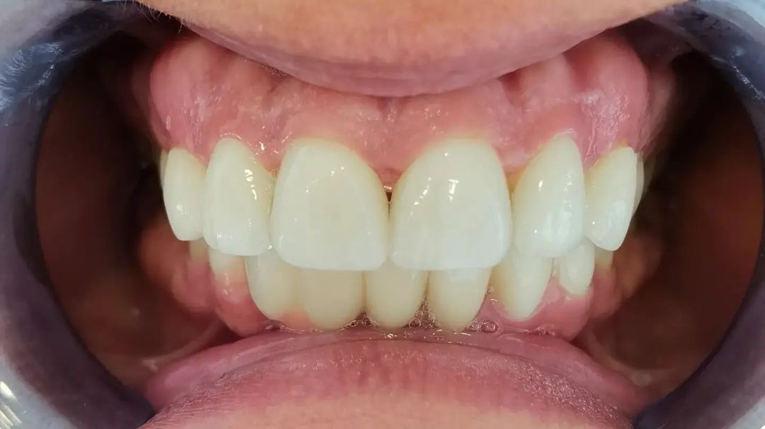 zirconia ve porcelain turkey