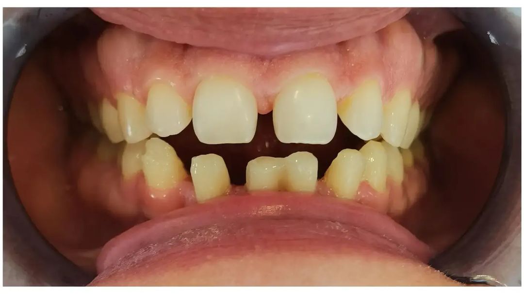 zirconia ve porcelain istanbul