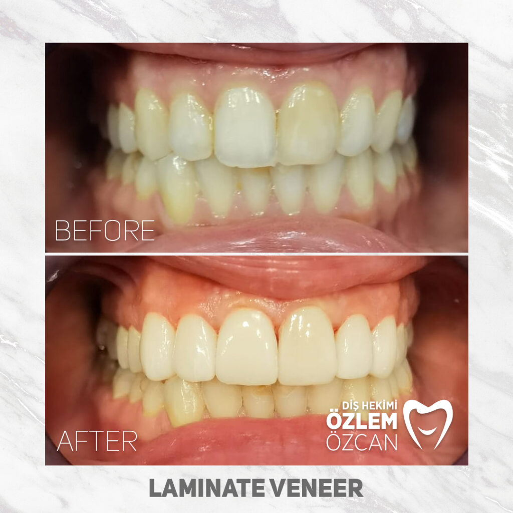 Dental Treatment in Turkey Without an Intermediary (No Commissions)