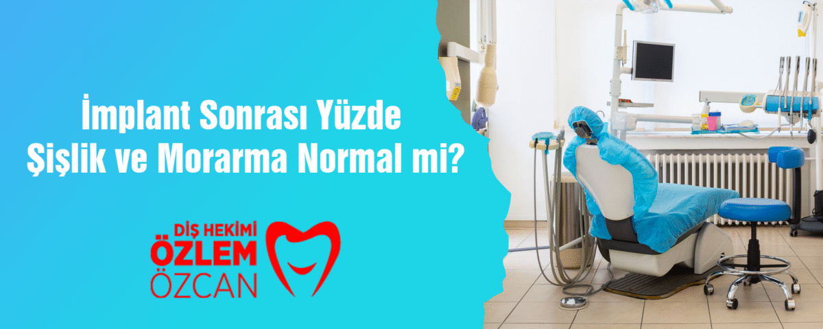 İmplant Sonrası Yüzde Şişlik ve Morarma Normal mi