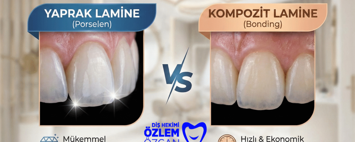 Yaprak Lamine (Veneer) ile Kompozit Lamine (Bonding) Farkı