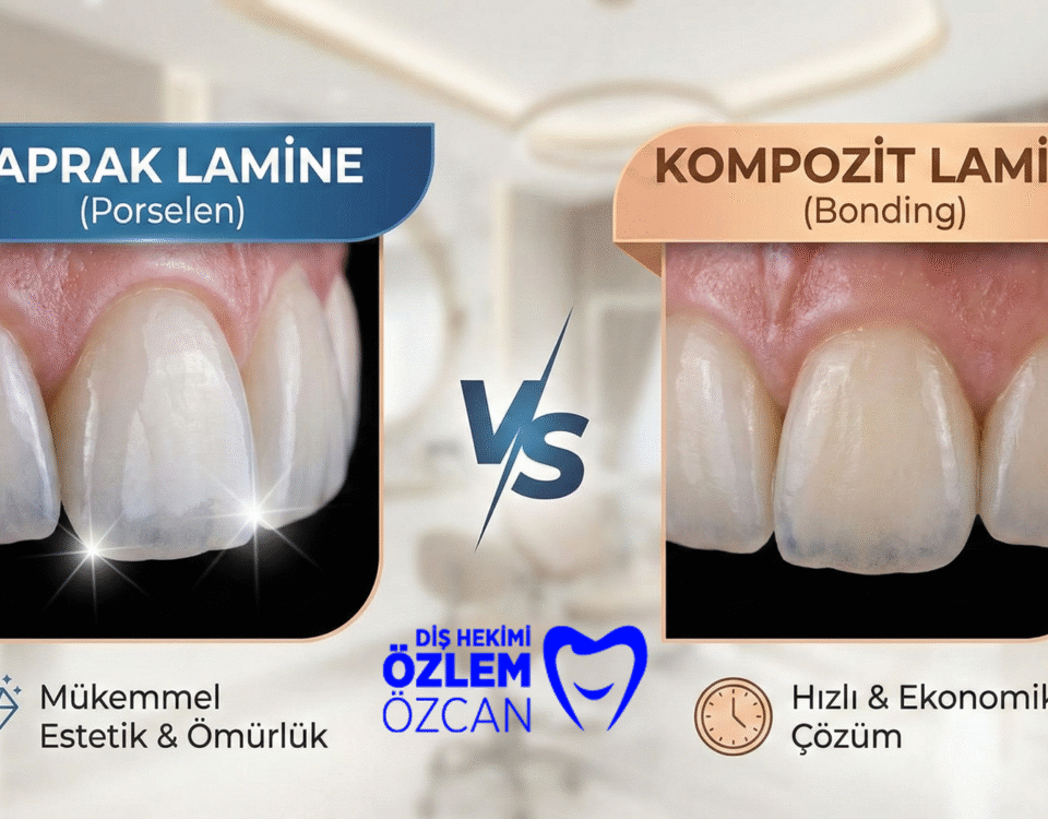 Yaprak Lamine (Veneer) ile Kompozit Lamine (Bonding) Farkı