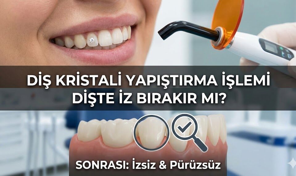 Diş kristali yapıştırma işlemi dişte iz bırakır mı