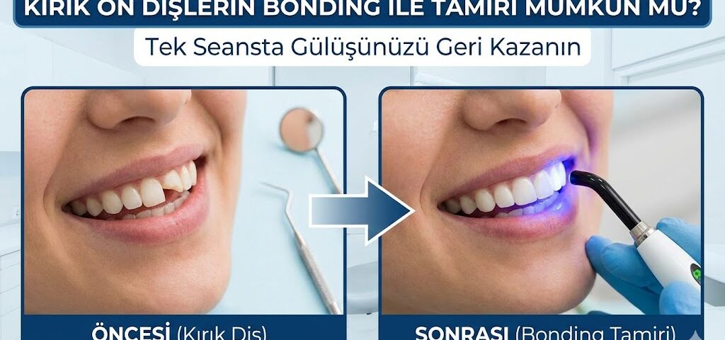 Kırık ön dişlerin bonding ile tamiri