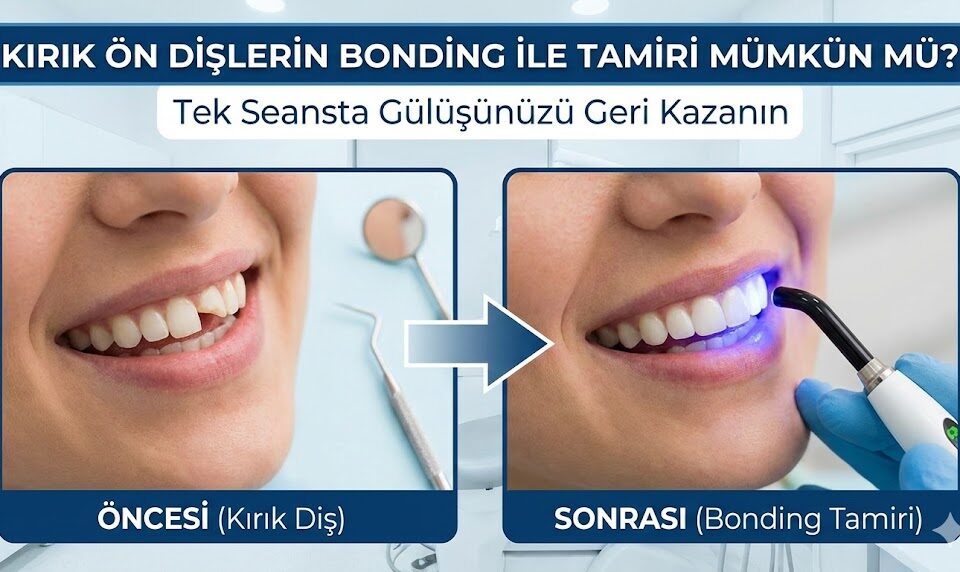Kırık ön dişlerin bonding ile tamiri
