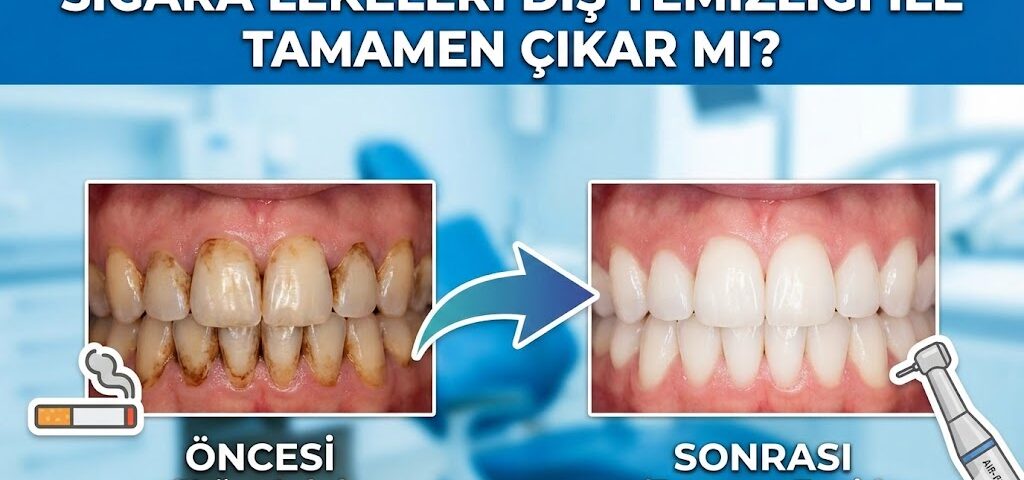 Sigara Lekeleri Diş Temizliği ile Tamamen Çıkar mı