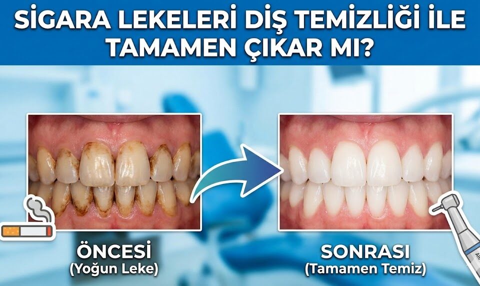 Sigara Lekeleri Diş Temizliği ile Tamamen Çıkar mı