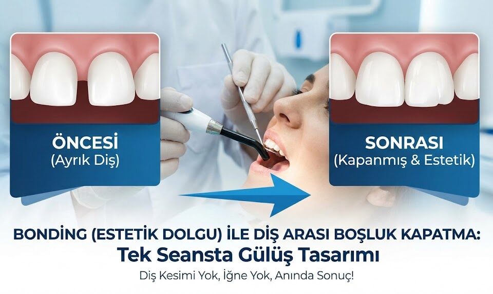 bonding ile diş arası boşluk kapatma
