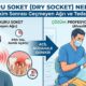 kuru soket nedir