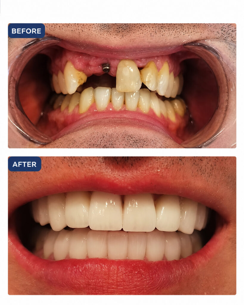 Laminate Veneers - before-after