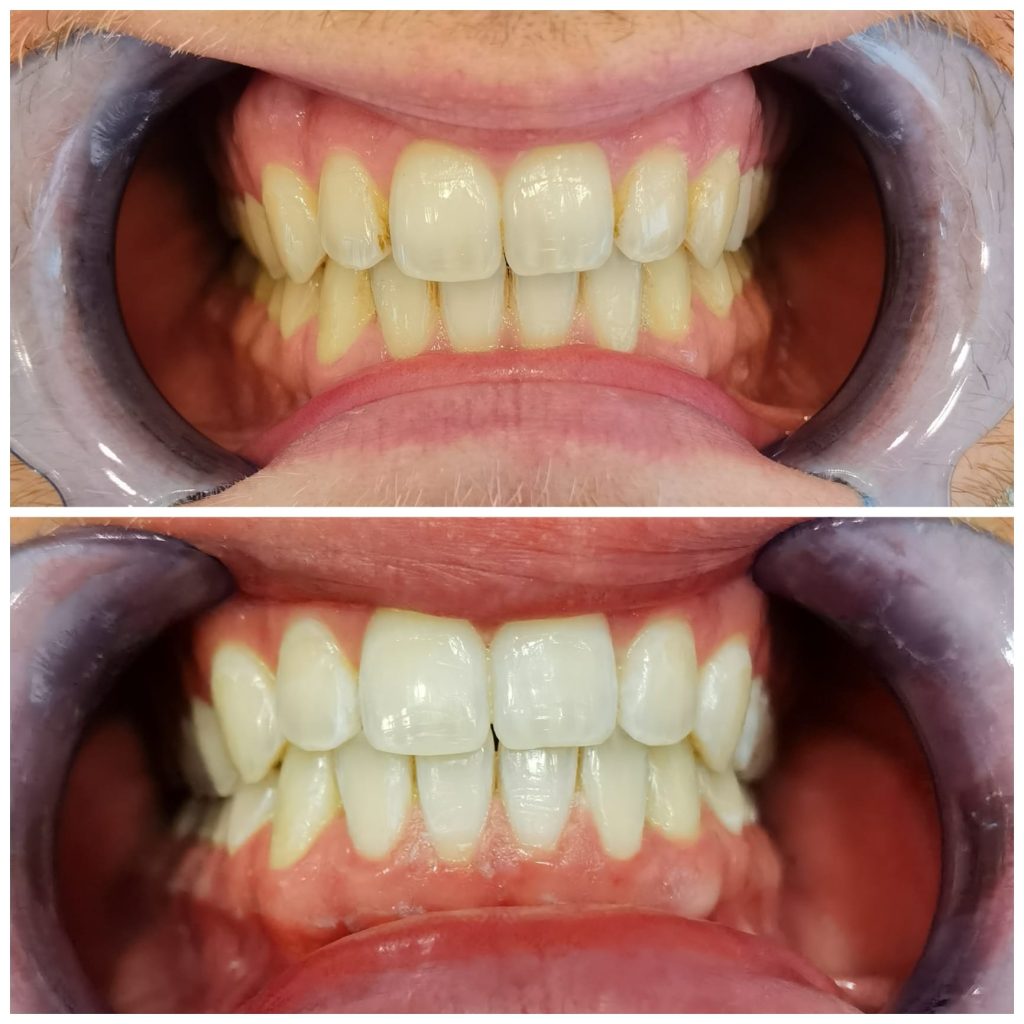 Teeth Whitening in Turkey Istanbul