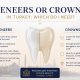Veneers or Crowns in Turkey: Which Do I Need? 2 Veneers or Crowns in Turkey: Which Do I Need