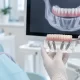 All-on-4 İmplant Nedir? Tedavi Süreci Ne Kadar Sürer? 2 All-on-4 İmplant Nedir? Tedavi Süreci Ne Kadar Sürer?