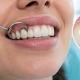 Kaplama Sonrası Diş Eti Kararması Neden Olur?