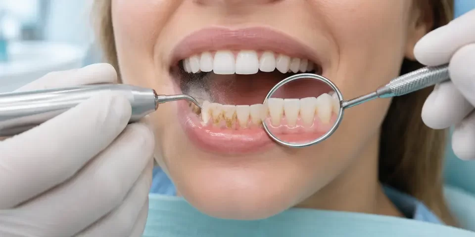 Diş Taşı Temizliği Nedir? Zararlı mı, Ne Sıklıkla Yapılır?
