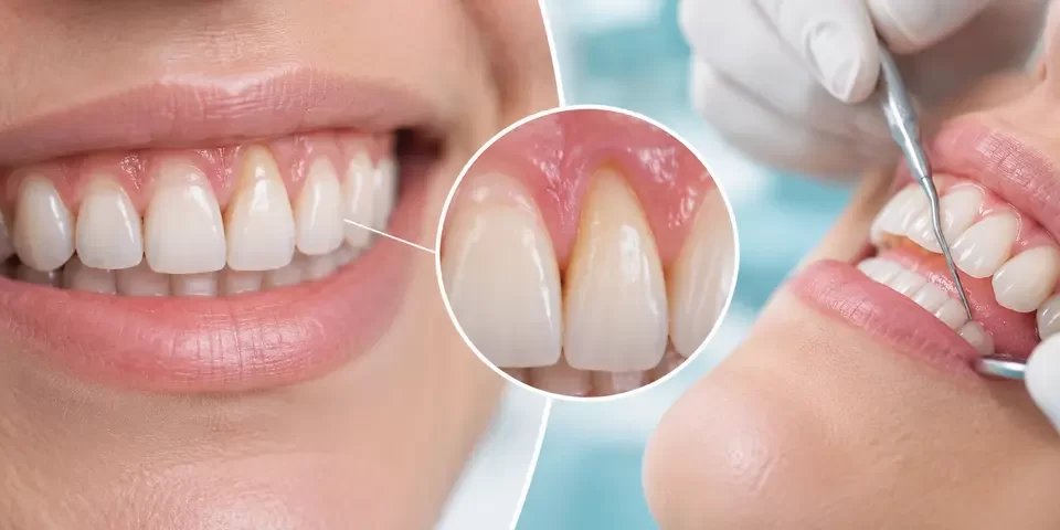 Diş Eti Çekilmesi Neden Olur? Tedavisi Mümkün mü?