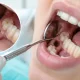 Kuru Soket (Dry Socket) Nedir? 3 Kuru Soket (Dry Socket) Nedir?