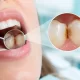 Diş Arası Çürükleri Neden Sinsi İlerler? 2 Diş Arası Çürükleri Neden Sinsi İlerler?