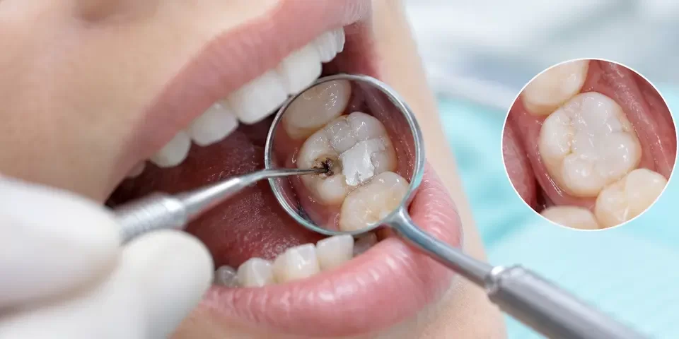 Dolgulu Diş Yeniden Çürür mü? Sekonder Çürük Nasıl Anlaşılır?