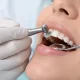 Diş Törpüleme (Enameloplasti) Zararlı mı? 3 Diş Törpüleme (Enameloplasti) Zararlı mı?