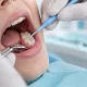 Fissür Örtücü Nedir? 2 Fissür Örtücü Nedir