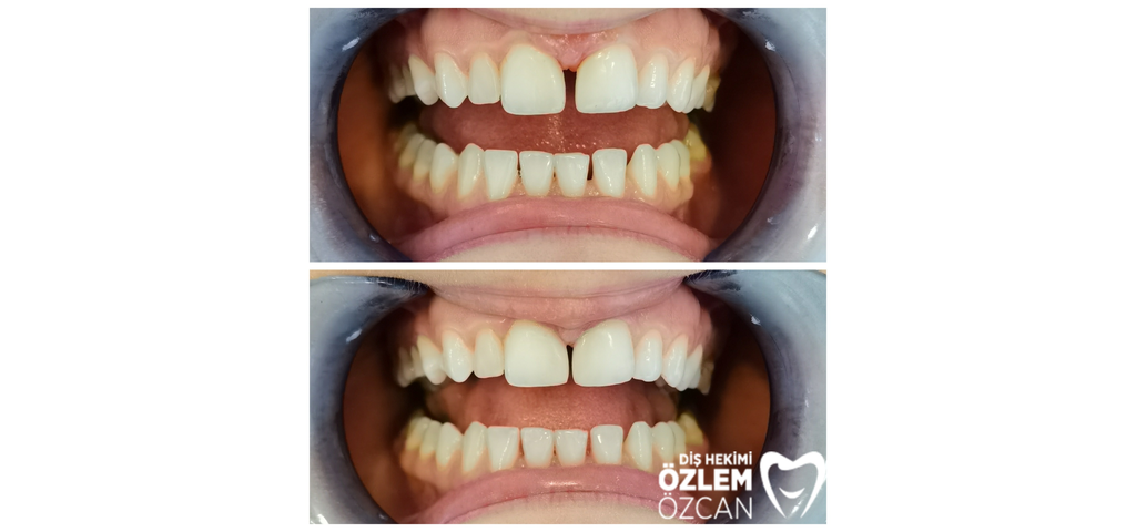 Ön dişlerde kompozit bonding uygulaması öncesi ve sonrası