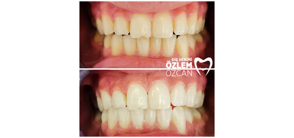Diş beyazlatma uygulaması öncesi ve sonrası ön diş görünümü