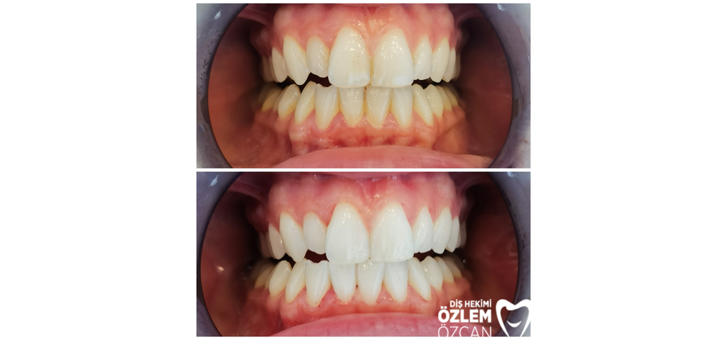 Profesyonel diş beyazlatma sonucu öncesi ve sonrası görünüm