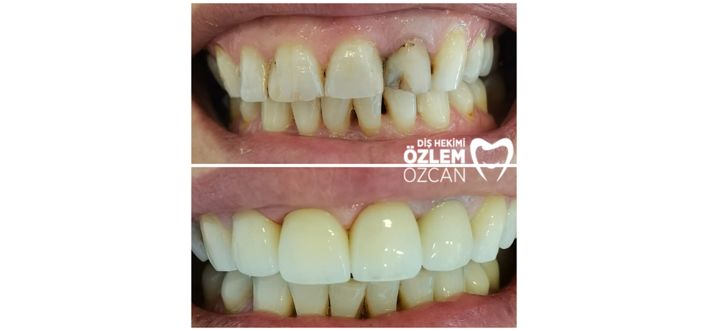 Diş dolgusu öncesi çürük ve kompozit restorasyon sonrası görünüm