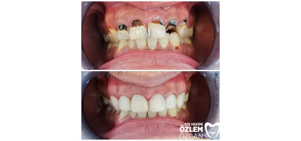 Kompozit diş dolgusu tedavisi öncesi ve sonrası karşılaştırma